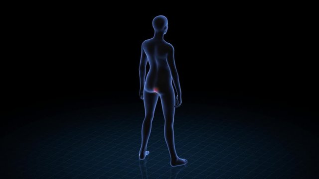 Girl with pathology. 3d body of women. Female human figure.