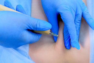 Doctor is making injection carbon dioxide in patient abdomen on carboxytherapy using special...