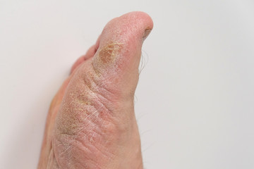 Fototapeta premium Fungus of the foot of a person.
