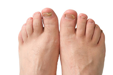 Fungus of toenails and human skin.
