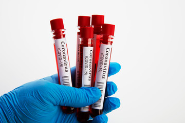 Coronavirus Blood Test in Laboratory