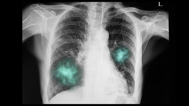 Chest xray film of a patient with severe pneumonia and bilateral pleural effusion in covid-19 vial lung infections.