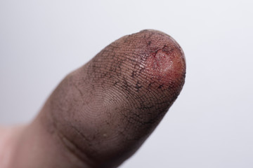 damaged bleeding finger of a person's hand
