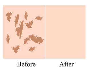 Pigmentation on the skin background. A pigmented spot on the skin of the face. Before and after treatment. Vector illustration