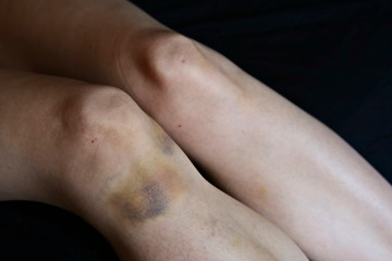 A large bruise on a woman's leg. Violence against women concept image. 