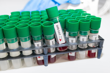 Coronavirus pandemic. Lab test tubes in rack. SARS-CoV-2 blood samples. COVID-19 testing clinic. Close-up of medical specimens in sterile plastic vials with green caps in laboratory. Global outbreak.