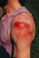 abrasion on human shoulder after skateboard accident