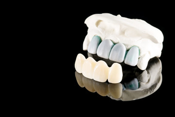 Closeup / Prosthodontics or Prosthetic / Tooth crown and bridge implant dentistry equipment and model express fix restoration.