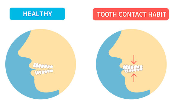 Tooth wear and TCH stress temporomandibular disorders