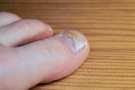 A damaged toenail on the big toe from a virus or enterovirus. There is a large crack on the nail and the result of exposure to the virus on the body. Taking care of your health.