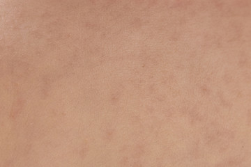 roseola rash a viral rash on the skin of a child