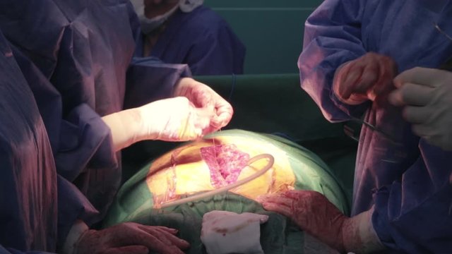 Doctors in a hospital stitch a stomach