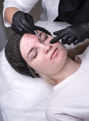 Procedure mechanical face cleaning in beauty salon. Young model getting cosmetic face skin care and treatments in cosmetologist. Acne treatment. Spa, cosmetology and wellness relaxation concept.