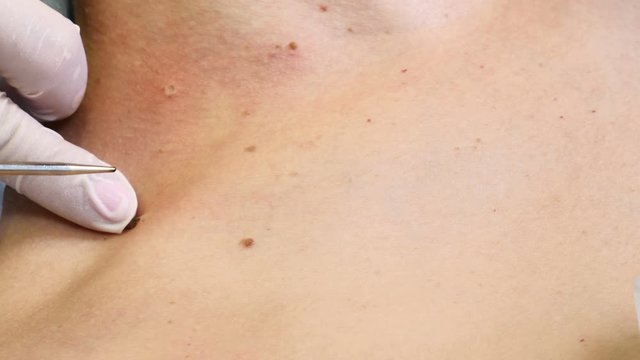 Surgery concept. Electrocoagulation of papillomas. Close-up shot of doctor burns papillomavirus with medical tools and equipment on female body. Papillomas removal. 4 k footage