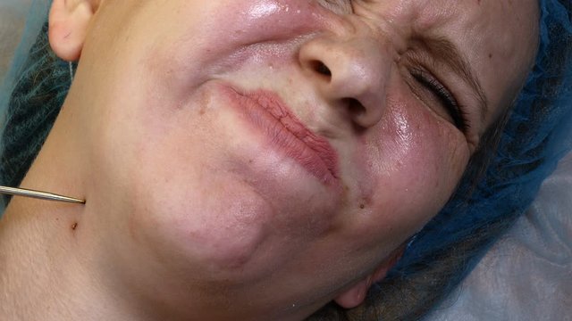 Surgery concept. Electrocoagulation of papillomas. Close-up shot of doctor burns papillomavirus with medical tools and equipment on female body. Papillomas removal. 4 k footage