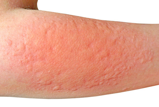 allergic reaction on the skin