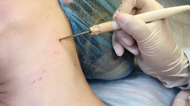 In beauty clinic. Beautician removs mole in surgical procedure by cutting it out with medical tools and equipment. Woman gets medical mole and papillomas removing in medical centre. 4k