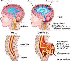 Medical illustration shows a child in two situations, left healthy and right afflicted by spina bifida with annotations explaining the symptoms of the pathology.