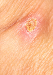 A wound from a knife cut on a person’s skin