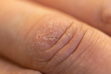 Fingerverletzung Kratzer