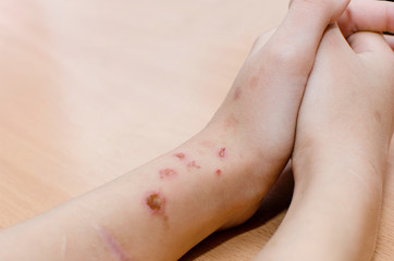 Scars from cuts and burns on the arm.