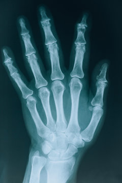 X-ray hand close-up. Real x-ray picture, hand and fingers