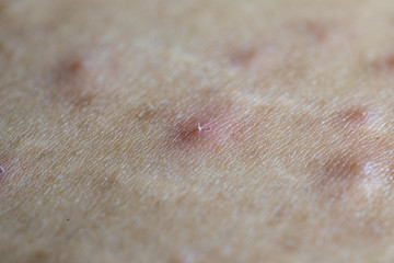 Acne on the human skin that is caused by the cover on the face.