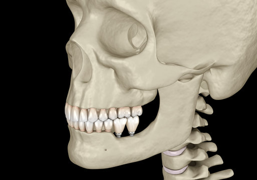 Implantation with mini implants in to recessed jaw bone: Medically accurate 3D illustration