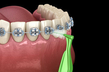 Interdental tooth brush and braces cleaning. Medically accurate 3D illustration of oral hygiene.