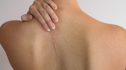 The scar on the bare back of a woman. Scoliosis of the spine. Medical content.