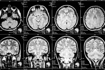 MR scan of female bran. Radiology concept