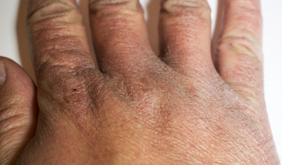 Man's hand with dry skin, cracked due to disinfectant solutions