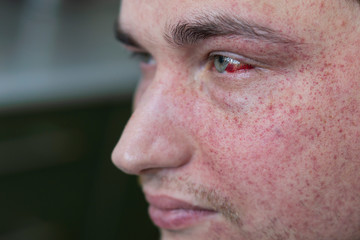 Young man with bursting capillaries on his face