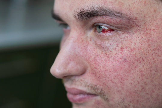 Young man with bursting capillaries on his face