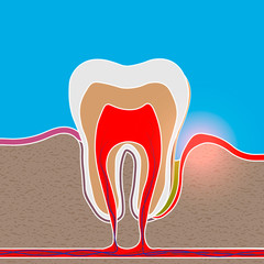 root inflammation, Gum disease, pus in the gum pocket, plaque and dental calculus. Periodontitis, Periodontitis, gingivitis