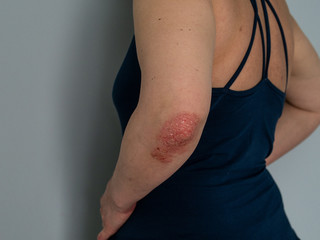 Psoriasis on elbow. Isolated. Closeup of rash and scaling on the patient's skin. The concept of chronic disease treatment. Dermatological problems. Hard, horny and cracked skin in woman's hands.