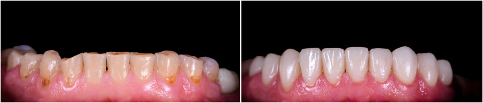 full mought recovery by press ceramic crowns and implants