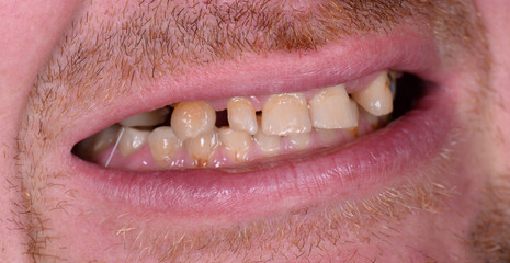 Obraz premium full mought recovery by press ceramic crowns and implants