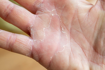 Hands damaged by disease of the skin. The skin on your hands will crawl. The skin is damaged