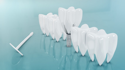 Fototapeta na wymiar Dental Implants surgery concept, dentistry denture, Dental denture on green background. 3D render.