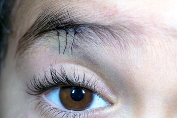 Obraz premium eyebrows Surgical suture, three nonabsorbable sutures