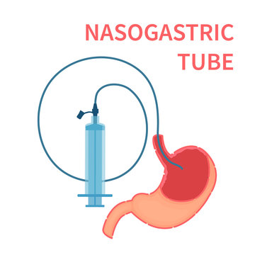 Nasogastric Tube Passed To Stomach Connected With A Syringe For Feeding And Administering Medication. Health Care And Emergency Medical Concept. Vector Illustration.