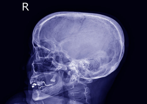 X-ray skull Finding The cranial vault is intact.No abnormal intra-cranial calcification or pneumocephalus is noted.The sella turcica looks narmal.Medical image concept.