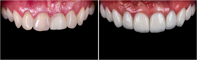 full upper jaw reconstraction by press cermic crowns and veneers