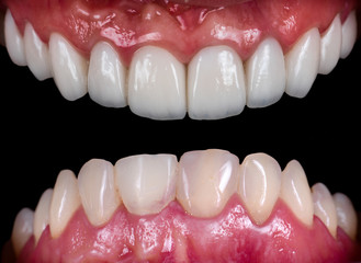 full upper jaw reconstraction by press cermic crowns and veneers © Garo