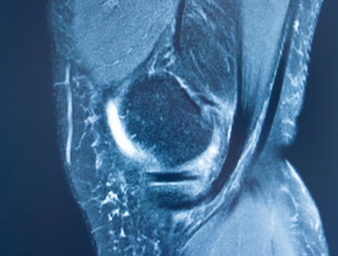 Knee Injury Mri Mcl Tear