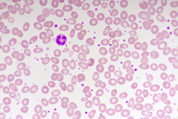 Essential thrombocytosis blood smear, present abnormal high platelet and white blood cell
