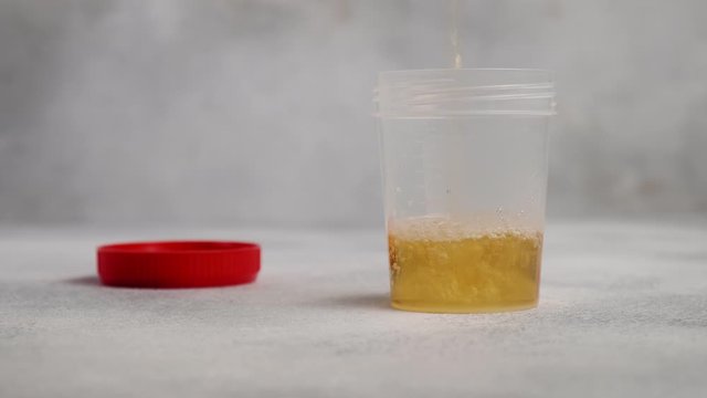 making urine test: filling plastic container cup with red cap with yellow liquid on grey background. specimen for hospital analysis. Medicine, healthcare, medical concept, clinical analysis, research
