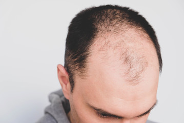Obraz premium Young man losing hair on temples, close up.
