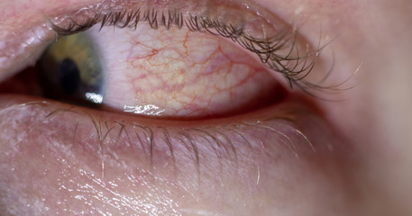 Inflamated eye infection. Red bloody eye closeup macro result of allergies and tiredness. Watery red skin around with healing creme applied